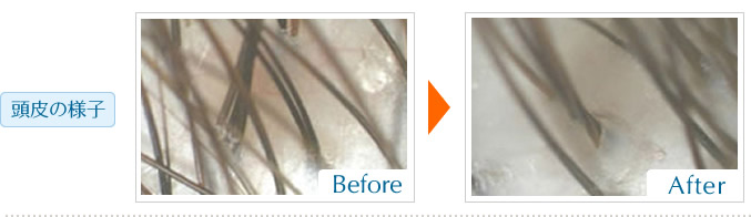 頭皮の様子  炭酸ヘッドスパ前後写真